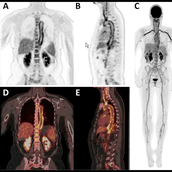 How Does PET Scan Work In Pyrexia Of Unknown Origin?